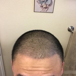 After-photo (2.5 weeks passing) After-photo (2.5 weeks passing)