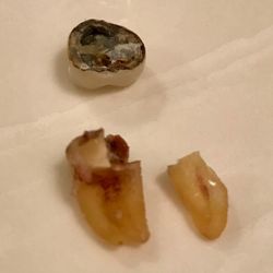 Anthony Torres DDS & Kevin Dorsey DDS - The fragments removed, with crown upside down.