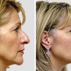 Jennifer Levine - Rhinoplasty