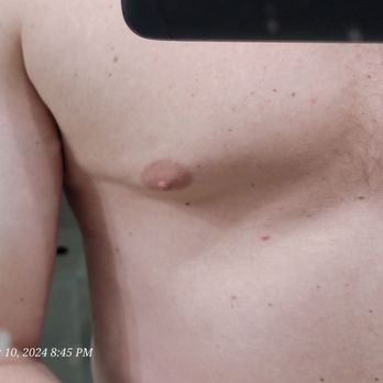 Elliot W. Jacobs, MD - This is flexing, nipple is puffy, clear case of gyno. - Cosmetic Surgeons Near Me - Boca Raton, Florida Elliot W. Jacobs, MD - This is flexing, nipple is puffy, clear case of gyno. - Cosmetic Surgeons Near Me - Boca Raton, Florida