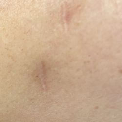 Derick Dermatology - Crystal Lake - Scars  on right arm of two other lipomas I had removed the same day. These are the scars I was Told I would have. I am okay with these
