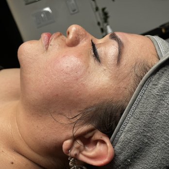 Bare Skin Aesthetics - Before sensitive skin facial - Estheticians Near Me - Henderson, Nevada