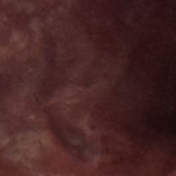 Brixton Family Dental - Oklahoma City - Deep cut under tongue caused by drunk dentist brewer