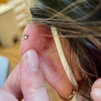 The Dogfather Tattoo - BEFORE: Embedded L Flat Piercing X2 - Tattoo Near Me - Fremont, California The Dogfather Tattoo - BEFORE: Embedded L Flat Piercing X2 - Tattoo Near Me - Fremont, California
