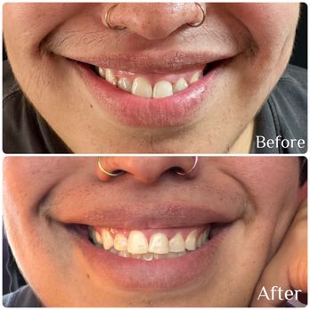 Contour & Sculpt Aesthetics - Client wanted a fuller lip but didn't want to commit to filler just yet, so we applied Daxxify and did a lip flip for a natural lift. - Aestheticians Near Me - Leander, Texas Contour & Sculpt Aesthetics - Client wanted a fuller lip but didn't want to commit to filler just yet, so we applied Daxxify and did a lip flip for a natural lift. - Aestheticians Near Me - Leander, Texas