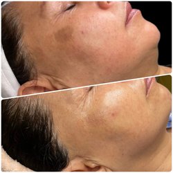 NewYou Skin and Body - Sun spot is improved by IPL