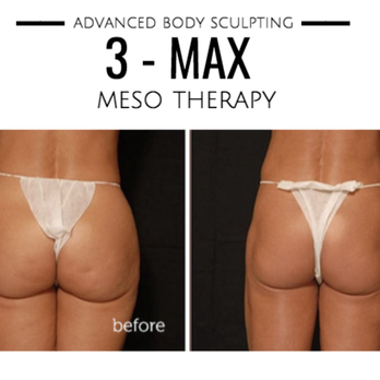 Genesys Laser - The Ultimate Sculpting Solution - Laser Hair Removal Near Me - Bayside, New York