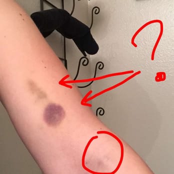 End Result Of An Iv Put In Banner Desert 2weeks Later Horrible
