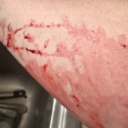 CSL Plasma - The blood that had dried on my lower arm
