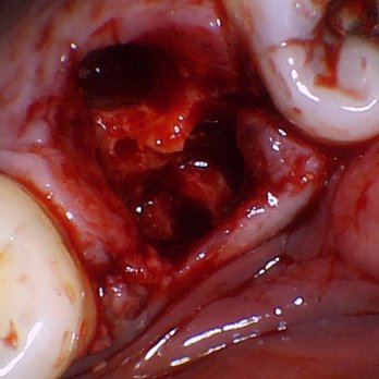 Blome Family Dentistry Dr Sara Wubbels - Attraction with abscess boil next to it - General Dentistry Near Me - Lincoln, Nebraska Blome Family Dentistry Dr Sara Wubbels - Attraction with abscess boil next to it - General Dentistry Near Me - Lincoln, Nebraska