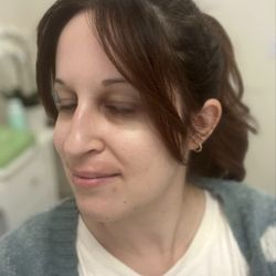 Smooth Sensation Electrolysis - Upper lip right after electrolysis