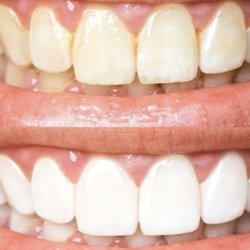 My Beautiful Smile Teeth Whitening