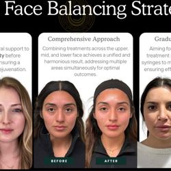 Face balancing with hyaluronic acid fillers and Botox