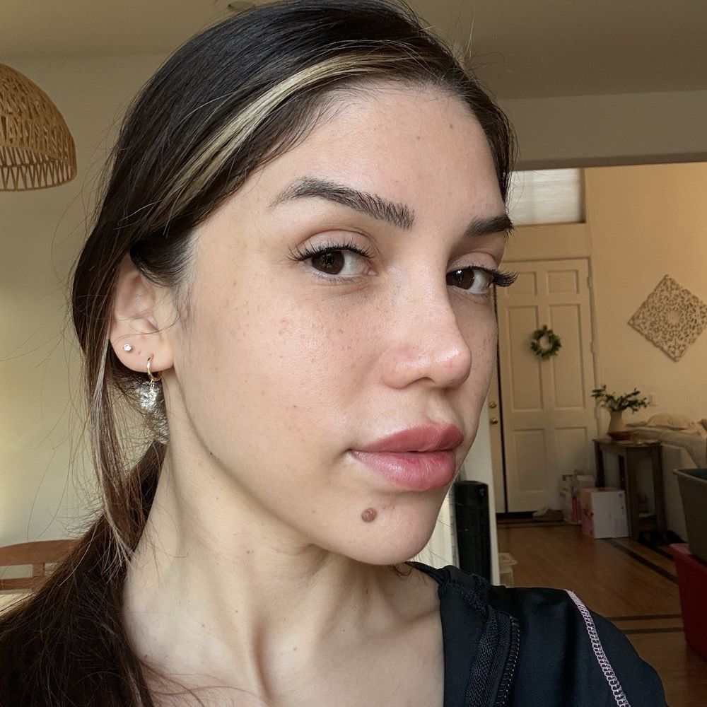 Cloud 9 Medi Spa - After 1 day , right side (facial symmetry) - Medical Spas Near Me - Yucaipa, California Cloud 9 Medi Spa - After 1 day , right side (facial symmetry) - Medical Spas Near Me - Yucaipa, California