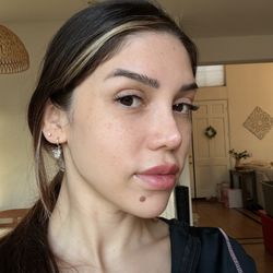 Cloud 9 Medi Spa - After 1 day , right side (facial symmetry)