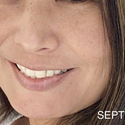 Okahara & Olsen MD - Pre-laser treatments