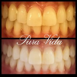 Pura Vida Esthetiques - $75 organic teeth whitening special!!Limited time only