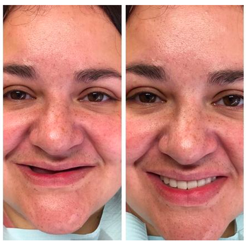 NÜVA Smile - Before & After at NÜVA Smile | East Brunswick, NJ - General Dentistry Near Me - East Brunswick, New Jersey NÜVA Smile - Before & After at NÜVA Smile | East Brunswick, NJ - General Dentistry Near Me - East Brunswick, New Jersey