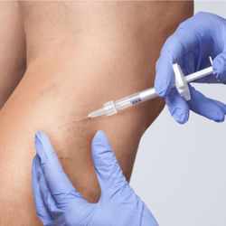 Safe and effective procedure based on infusion of concentrated saline to shrink and fade spider veins