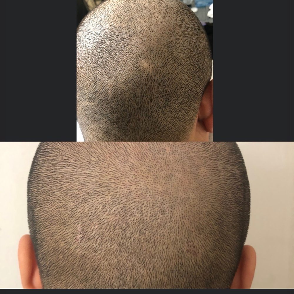 Sterling Scalp - Scars disappeared like magic! - Hair Loss Centers Near Me - San Leandro, California