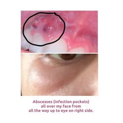 Youngsville Dental Care - My entire right side of my face covered in infection could have gotten into my brain and killed me.