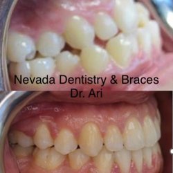 Nevada Dentistry & Braces - Bite correction right side view
