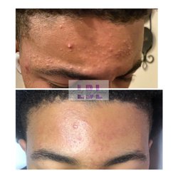 Laced by Lonice Spa and Boutique - We are excellent to get your rid of your acne!