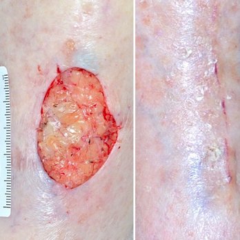 Adam M Rotunda, MD - After Mohs surgery for a large skin cancer on the leg and after 3 weeks of reconstruction and steadfast wound care. - Dermatologists Near Me - Newport Beach, California Adam M Rotunda, MD - After Mohs surgery for a large skin cancer on the leg and after 3 weeks of reconstruction and steadfast wound care. - Dermatologists Near Me - Newport Beach, California