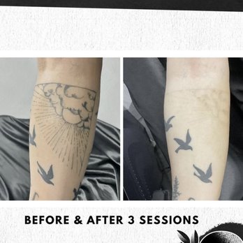The Ink Nurse - Tattoo Removal Near Me - Las Vegas, Nevada The Ink Nurse - Tattoo Removal Near Me - Las Vegas, Nevada