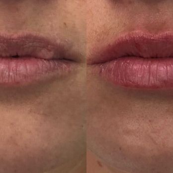 AnwarMD.com - Before and after - Medical Spas Near Me - Roseville, California