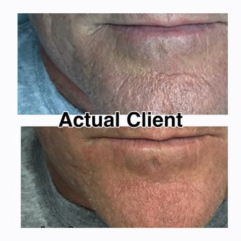 Bella Skin Care Pros - HydraFacial & MicroNeedling are great for men too! - Skin Care Near Me - Stuart, Florida Bella Skin Care Pros - HydraFacial & MicroNeedling are great for men too! - Skin Care Near Me - Stuart, Florida