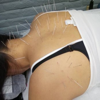 Northridge Acupuncture - Acupuncture Near Me - Reseda, California Northridge Acupuncture - Acupuncture Near Me - Reseda, California