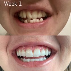 Peter V Le, DDS - Before and After with 1 year of Invisalign!