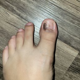 Fungal infected toe :( i have medication on it and thats why it looks shiny.