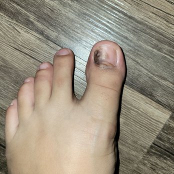 Us Nails & Spa - Fungal infected toe :( i have medication on it and thats why it looks shiny. - Nail Salons Near Me - Chino Hills, California