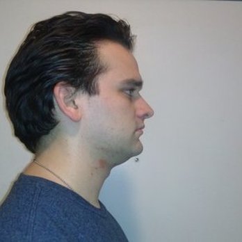 Michael J Yaremchuk, MD - before - Plastic Surgeons Near Me - Boston, Massachusetts Michael J Yaremchuk, MD - before - Plastic Surgeons Near Me - Boston, Massachusetts