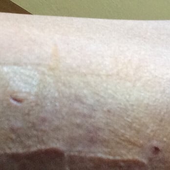 Matthew W. Guile, M.D - The implant in my arm without numbing medication and a long mark that should not be there. - Obstetricians & Gynecologists Near Me