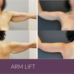 Dr. Carmina Cardenas - Arm Lift
