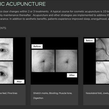 Michelle M. Ching, L.Ac. - Before and After photos of Michelle's cosmetic acupuncture patients https://michellemching.com/cosmetic - Acupuncture Near Me - Los Angeles, California Michelle M. Ching, L.Ac. - Before and After photos of Michelle's cosmetic acupuncture patients https://michellemching.com/cosmetic - Acupuncture Near Me - Los Angeles, California