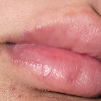 LaserAway - "Healed" according to Laseraway's standards - Medical Spas Near Me - Roseville, California