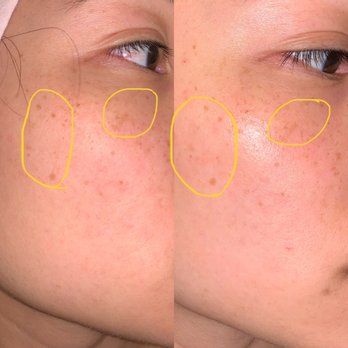 Beauty Unlimited - Left (Feb 23, 2019), Right (Apr 12, 2019) - Massage Near Me - Alameda, California