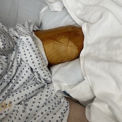 Genesis Healthcare - Woodmont Center - My fathers leg amputation after Woodmonts neglect