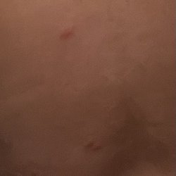 Valli-Hi Motel - A few bites from the bed bugs!