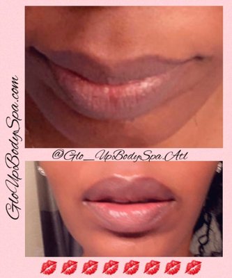 Derma Filler Injectables & Needle-Free Derma Fillers - Our Derma Fillers such as (Juvederm, Restlyan), and Hyaluronic Acid only reaches the papillary layer of the dermis making this a safe treatment with no risk of occlusion as well as no sharp tips to puncture blood vessels.
Hyaluronic Acid Promotes Healthier, More Supple Skin. When applied to the surface of the skin, hyaluronic acid serums can reduce wrinkles, fine lines and redness.
What is involved in the procedure?
The procedure is quite simple and the Derma Fillers/Hyaluronic Acid used is safe as the human body produces the exact same acid, it is pretty impossible that anyone would get any sort of allergic reaction or complication from the HA itself. The more Filler that is inside the Epidermis layer of the skin, the more water is retained keeping its moisture and making the appearance of the skin more youthful.
Hyaluron PEN Device
The hyaluronic pen is a device that has a piston with a spring that provides a quick administration of hyaluronic acid or other Derma Fillers into your skin. The microscopic hole it puts in your skin is how the Hyaluron pen administers the acid under the skin. The hyaluronic acid/Filler is absorbed and distributed under your skin better than if you were injected with a needle.
Advantages of The Hyaluron PEN:
– Painless Better and faster absorption of Hyaluronic Acid/Filler
– Needleless volume build-up for lips, Needleless wrinkle reduction of the nasolabial folds and marionettes
– Safe handling due to modifiable quantity and barrier protection technology
– Fast working due to multi-shot system, easy and safe
– High customer satisfaction and loyalty Derma Filler Injectables & Needle-Free Derma Fillers - Our Derma Fillers such as (Juvederm, Restlyan), and Hyaluronic Acid only reaches the papillary layer of the dermis making this a safe treatment with no risk of occlusion as well as no sharp tips to puncture blood vessels.
Hyaluronic Acid Promotes Healthier, More Supple Skin. When applied to the surface of the skin, hyaluronic acid serums can reduce wrinkles, fine lines and redness.
What is involved in the procedure?
The procedure is quite simple and the Derma Fillers/Hyaluronic Acid used is safe as the human body produces the exact same acid, it is pretty impossible that anyone would get any sort of allergic reaction or complication from the HA itself. The more Filler that is inside the Epidermis layer of the skin, the more water is retained keeping its moisture and making the appearance of the skin more youthful.
Hyaluron PEN Device
The hyaluronic pen is a device that has a piston with a spring that provides a quick administration of hyaluronic acid or other Derma Fillers into your skin. The microscopic hole it puts in your skin is how the Hyaluron pen administers the acid under the skin. The hyaluronic acid/Filler is absorbed and distributed under your skin better than if you were injected with a needle.
Advantages of The Hyaluron PEN:
– Painless Better and faster absorption of Hyaluronic Acid/Filler
– Needleless volume build-up for lips, Needleless wrinkle reduction of the nasolabial folds and marionettes
– Safe handling due to modifiable quantity and barrier protection technology
– Fast working due to multi-shot system, easy and safe
– High customer satisfaction and loyalty