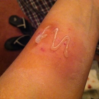 Mount Sinai Brooklyn - Cat Bite - Hospitals Near Me - Brooklyn, New York