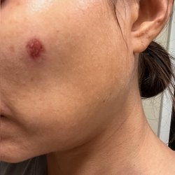 Red Bamboo Medi-Spa - Red Bamboo scarred my face!