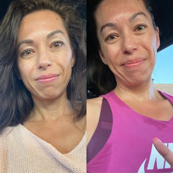 Skin Medica MD - Before and after photos with fillers in cheeks to lessen smile lines and boost cheek pads. - Medical Spas Near Me - Benicia, California