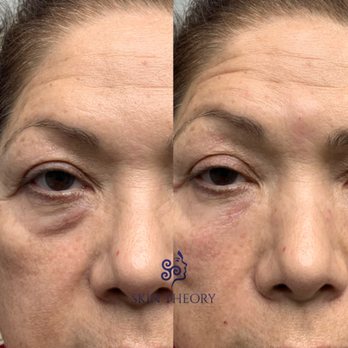 Skin Theory - Skin and Derm Theory Dermal Filler Before and After-January 2024 - Laser Hair Removal Near Me - Corona, California Skin Theory - Skin and Derm Theory Dermal Filler Before and After-January 2024 - Laser Hair Removal Near Me - Corona, California