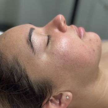 Fadia Beauty - First treatment. Facial and RF face life - Estheticians Near Me - Los Angeles, California Fadia Beauty - First treatment. Facial and RF face life - Estheticians Near Me - Los Angeles, California