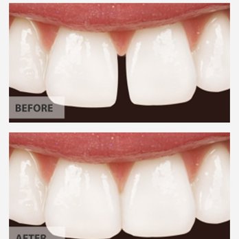 Morrison Dental Care - Dental bridges Clifton Park - Cosmetic Dentists Near Me - Clifton Park, New York Morrison Dental Care - Dental bridges Clifton Park - Cosmetic Dentists Near Me - Clifton Park, New York
